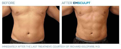 Emsculpt NEO Before and After .